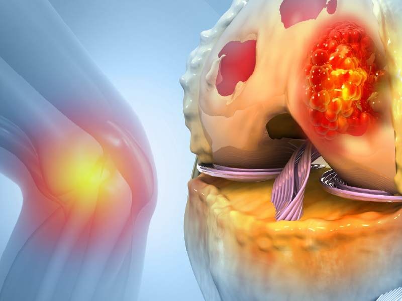 Treating TGCT