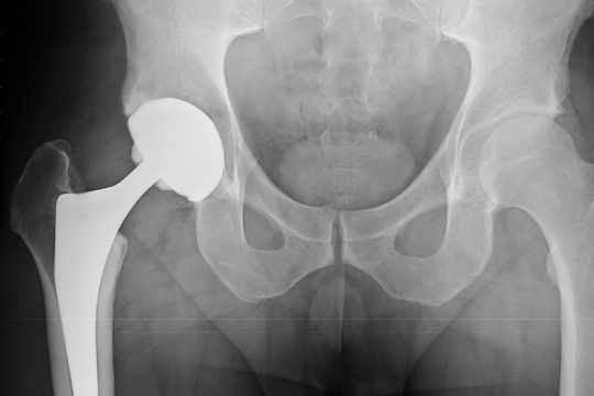 Periprosthetic Fractures: The New Osteoporotic Fragility Epidemic