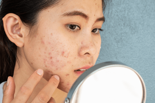 A New Treatment For Acne Vulgaris