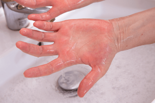 Yes, You Really Can Be "Allergic" to the Cold 