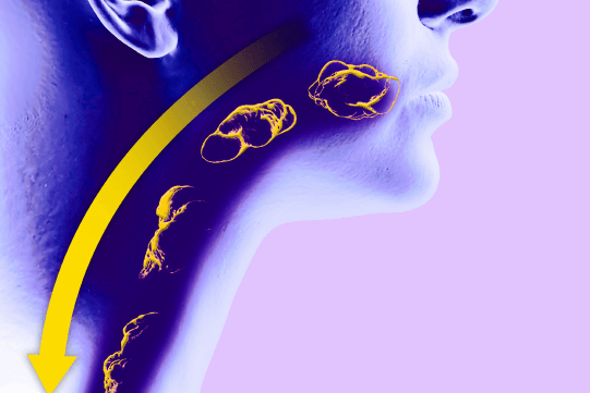 Dupilumab Now Approved for Eosinophilic Esophagitis