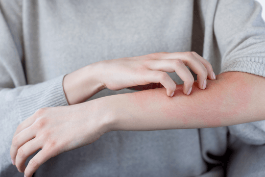 JAK Inhibitors for the Management of Atopic Dermatitis